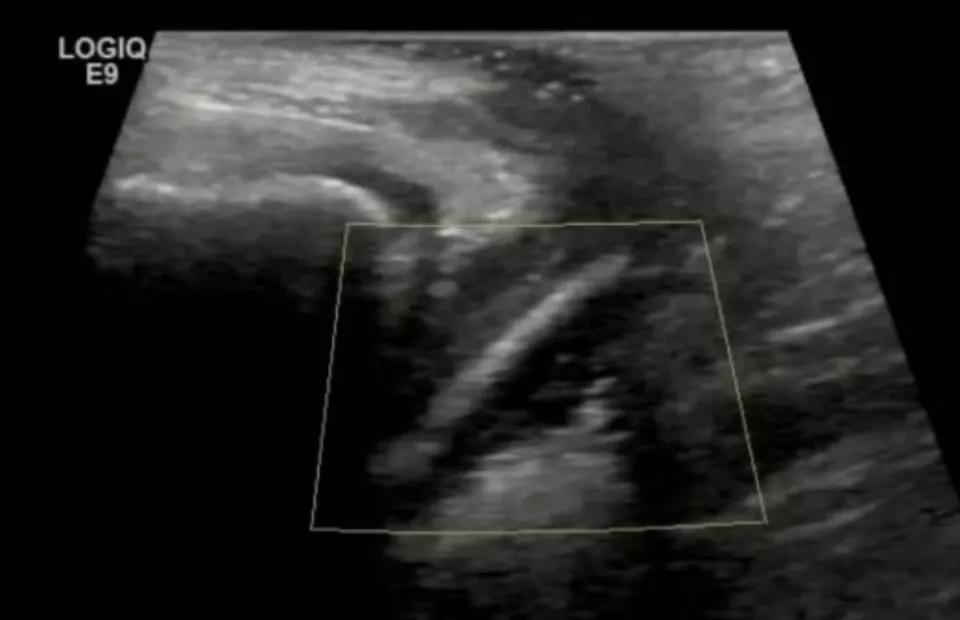 万万没想到！近日，广东，一7岁女孩阴道炎反反复复，家长试过什么办法都不见好，无奈