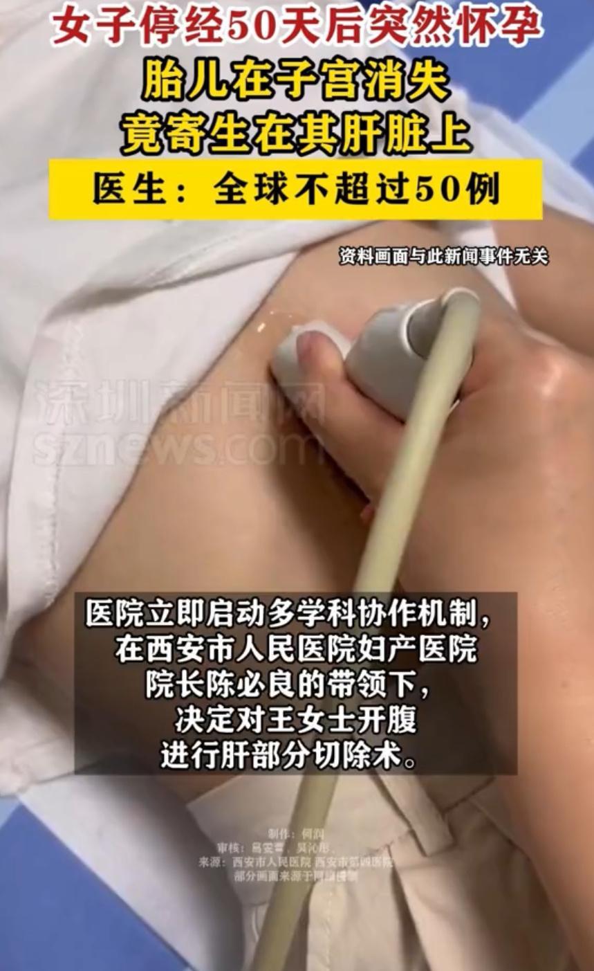 胎儿在子宫消失竟寄生在母亲肝脏上40岁王女士停经后确诊怀孕，子宫内却遍寻不到孕囊