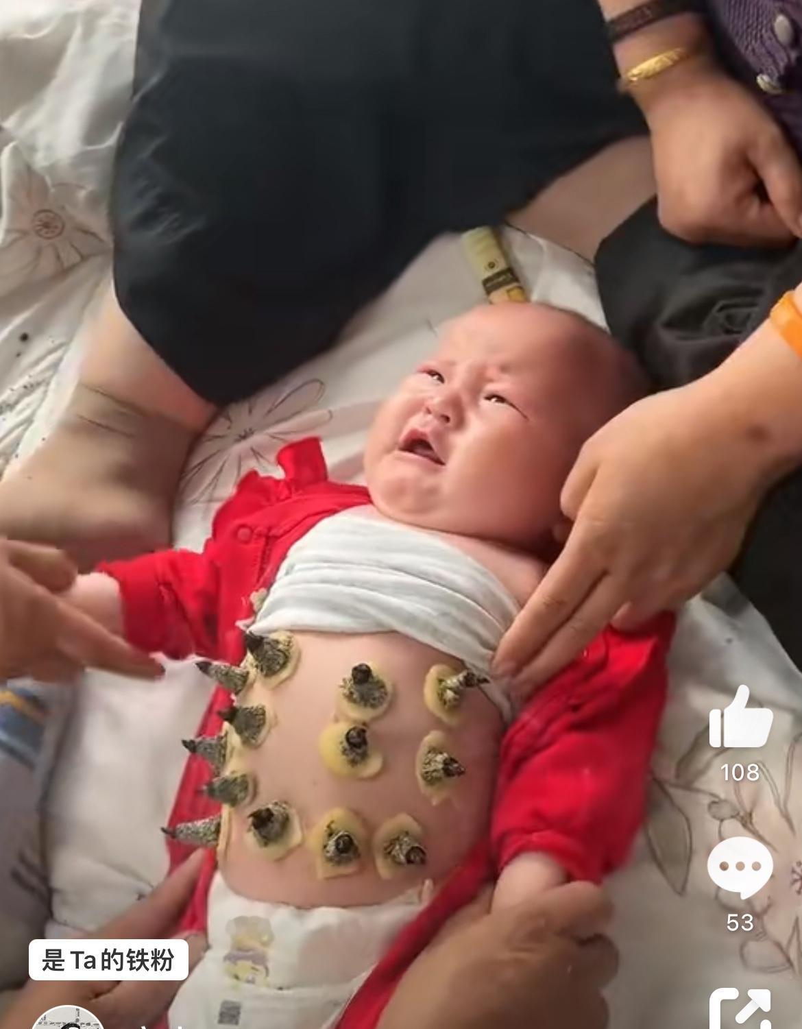 小婴儿用艾灸，这是典型的大人有病，小孩吃药。据说叫隔姜灸，小孩在那里不停的哭，就