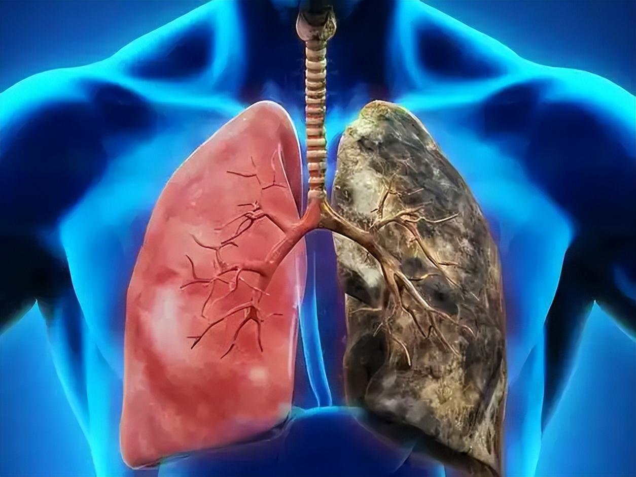 创新药械|国家药监局附条件批准又一款肺癌创新药，精准破局难治亚型近日，国家