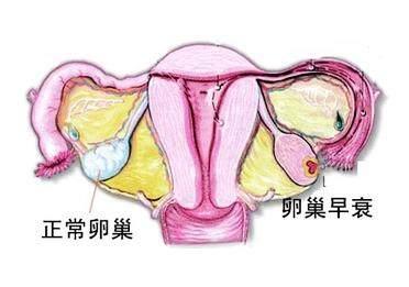 卵巢功能早衰或引发不孕?