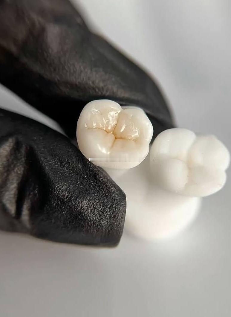 蛀牙的治疗从早期干预到根管治疗蛀牙的发生是一个渐进的过程，从牙齿表面出现微小的脱