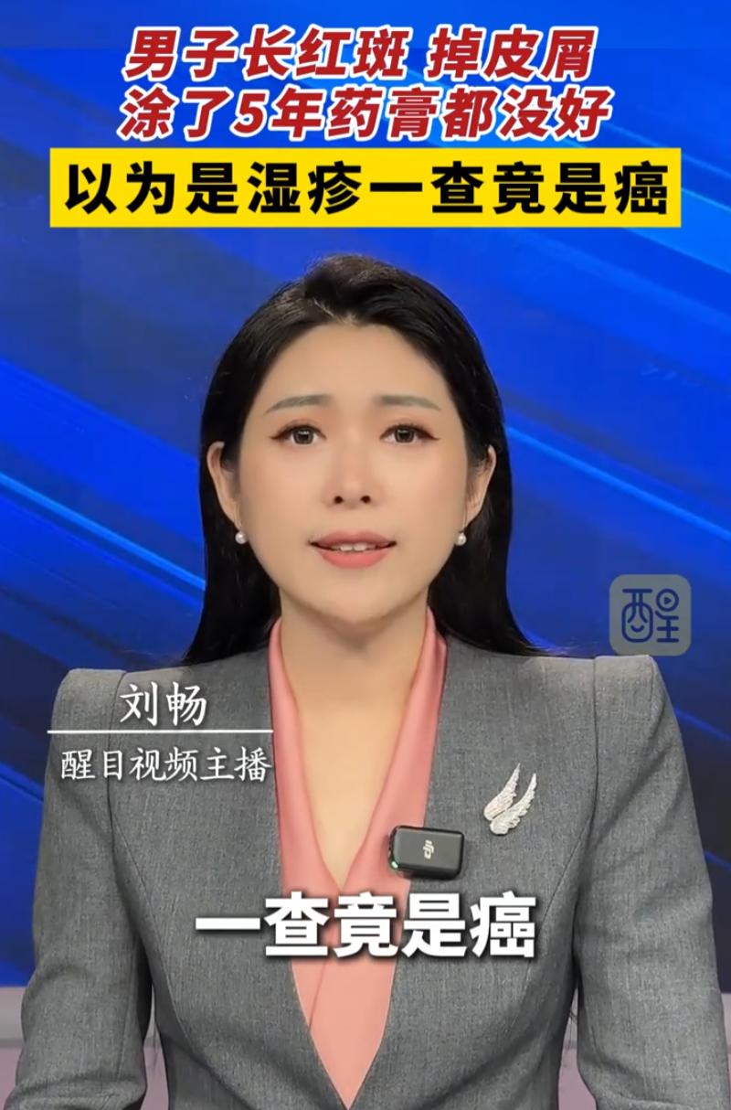浙江宁波，男子发现近几年皮肤经常出现红斑、掉皮屑的情况，他一直以为是湿疹，涂了5