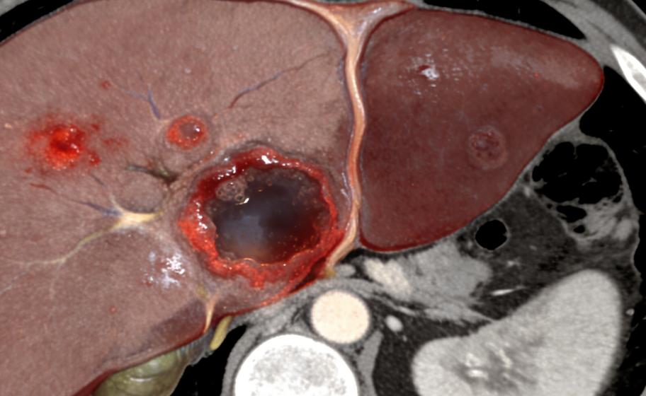 以为只是小炎症，拖久差点出大事，肝脓肿这些信号一定要早知道很多人都有过这种想