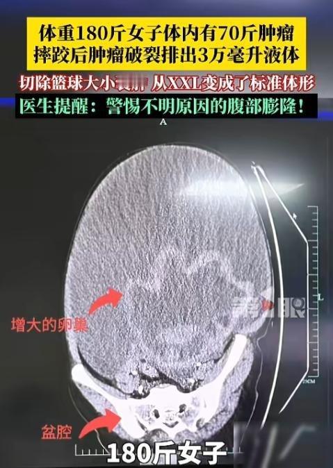 “离大谱！”浙江女子减肥多年，180斤体重纹丝不动，没想到摔了一跤后，肚子竟然跟