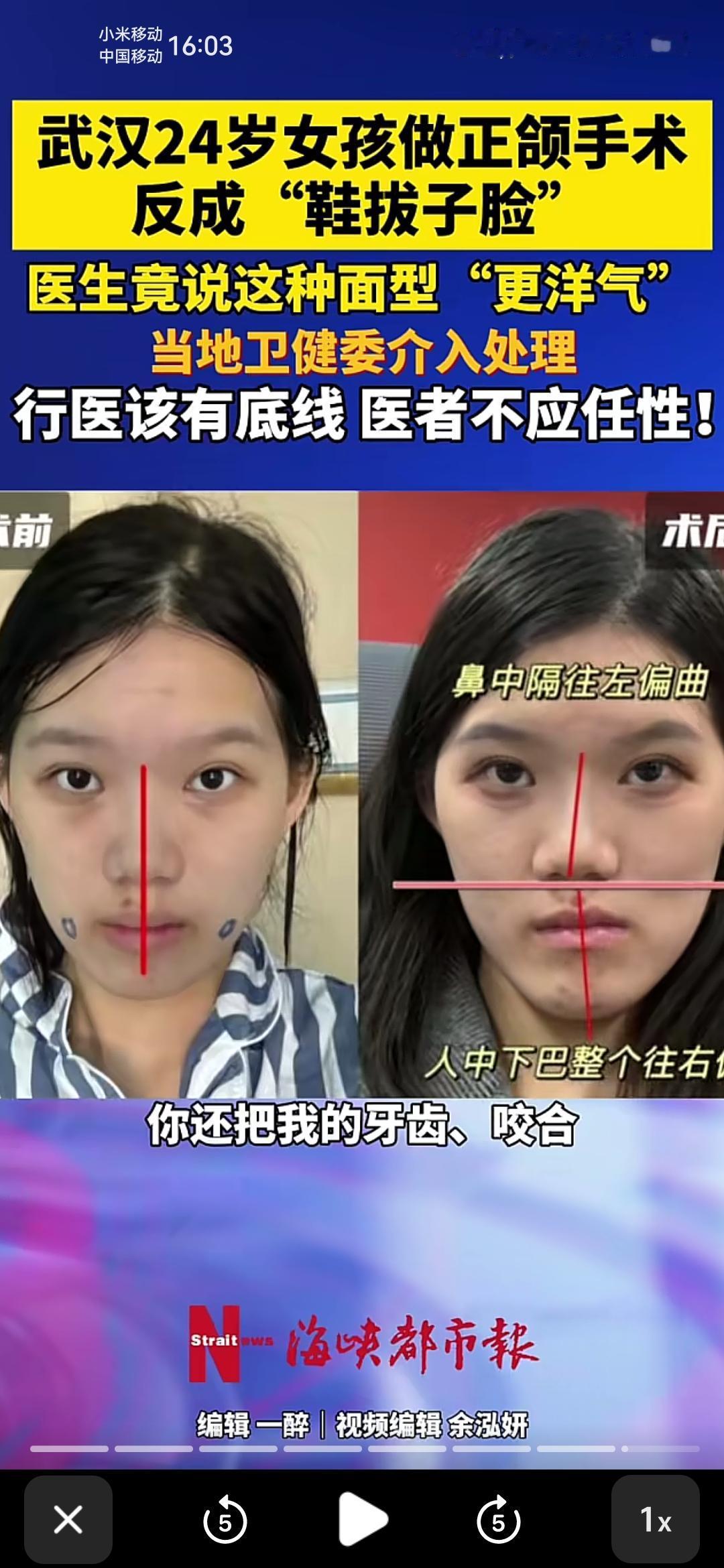 她现在的核心问题已经不是好不好看了，是功能性问题。下巴有一颗该拔的钉子没拔出来，