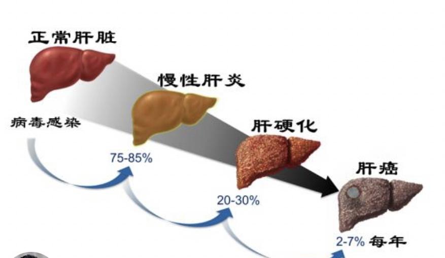 这3个变化说明你的肝病越来越好了！ 1.睡眠质量提高：当肝病在逐渐好转...