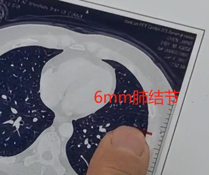 肺结节什么情况下才叫“有进展”？我们在观察期间，如果发现肺结节有变化，才会考虑进