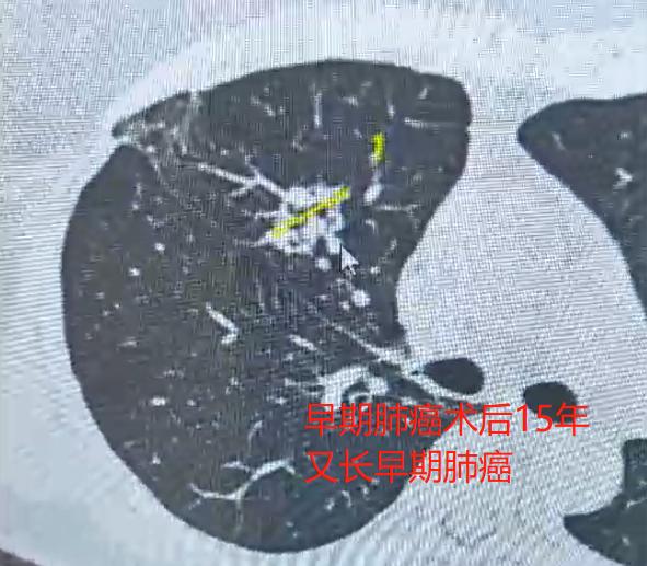 肺癌患者熬过5年就安全了吗？一位术后满6年的患者来复查时问我：