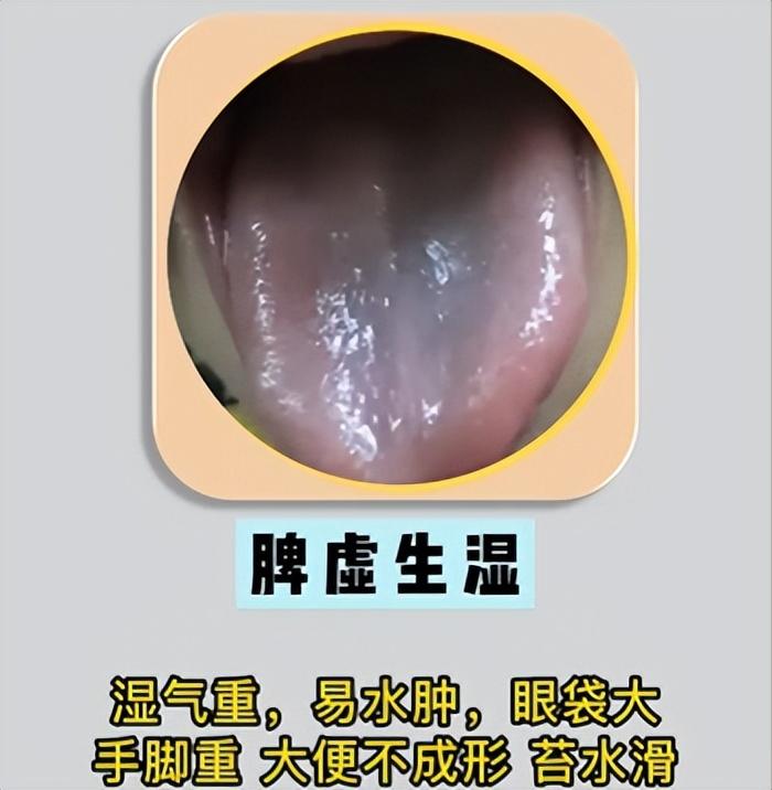 4种脾虚，快看你属于哪一种~