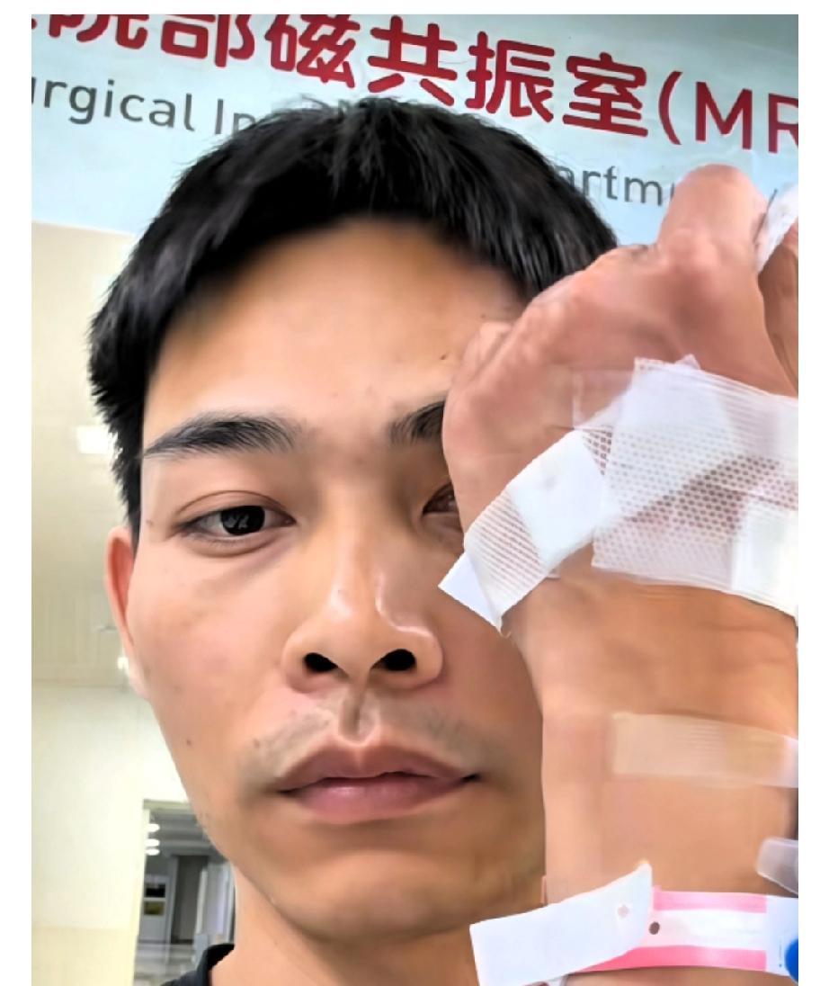 肝癌化疗者用他虚弱身体救了三个人31岁的潘先生，刚结束一轮化疗，身子还很