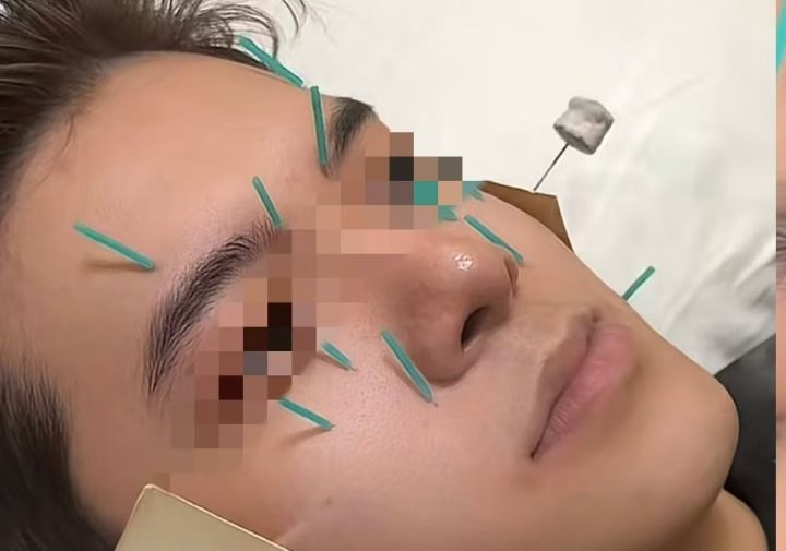 知名艺人节目中体验中医医美, 脸变小, 眼睛变大! 医生揭秘原理