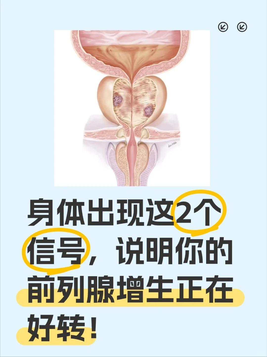前列腺正在好转的2大信号！