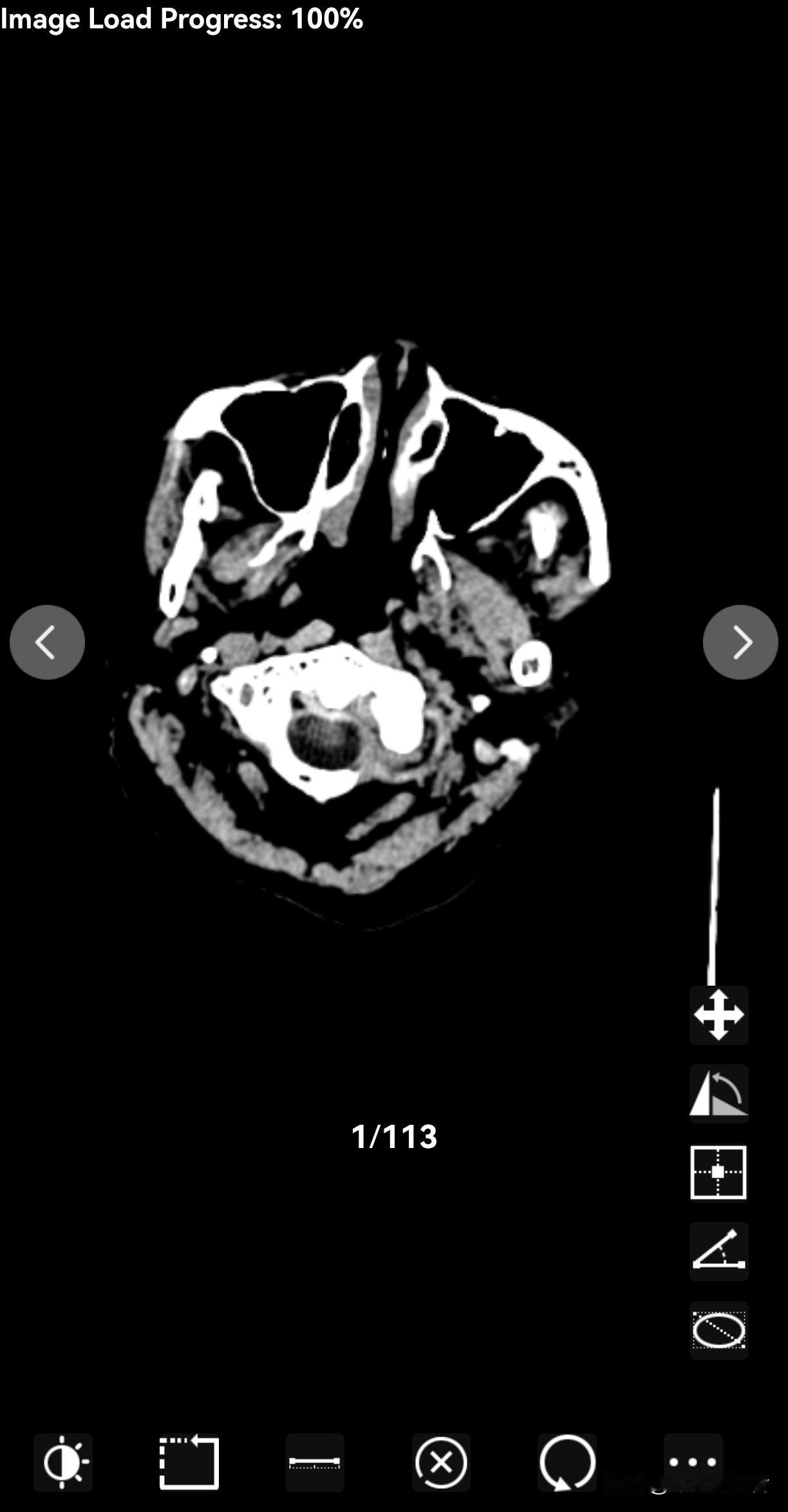 我妈妈12月19日因为血压高导致摔倒，接着不能说话，同时也不能自己单独走路。然