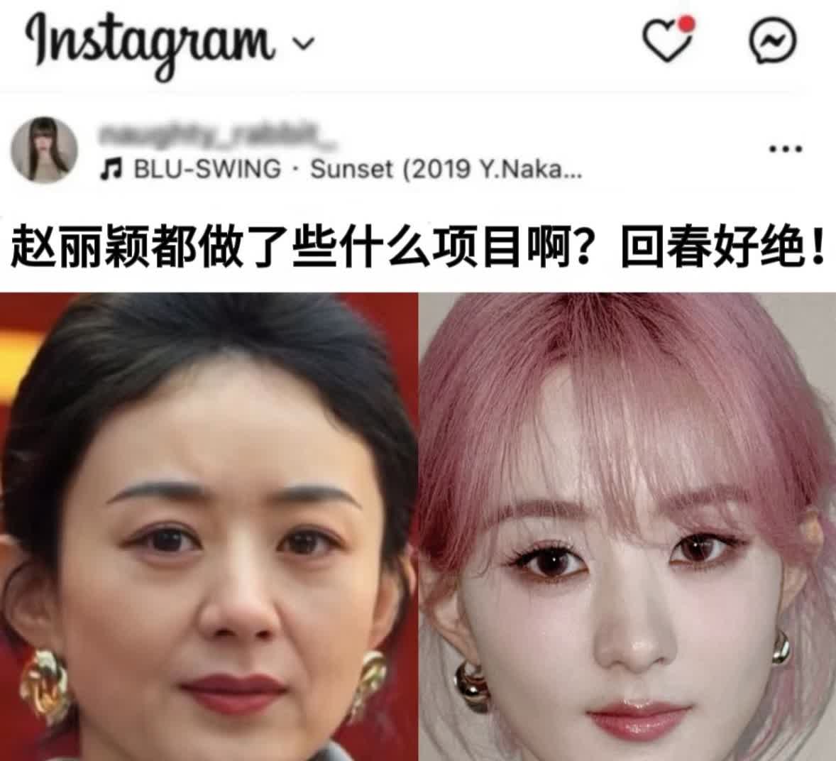 赵丽颖做的抗衰项目能不能公开一下啊我发现在抗衰这条路上圆脸真的很容易弯道