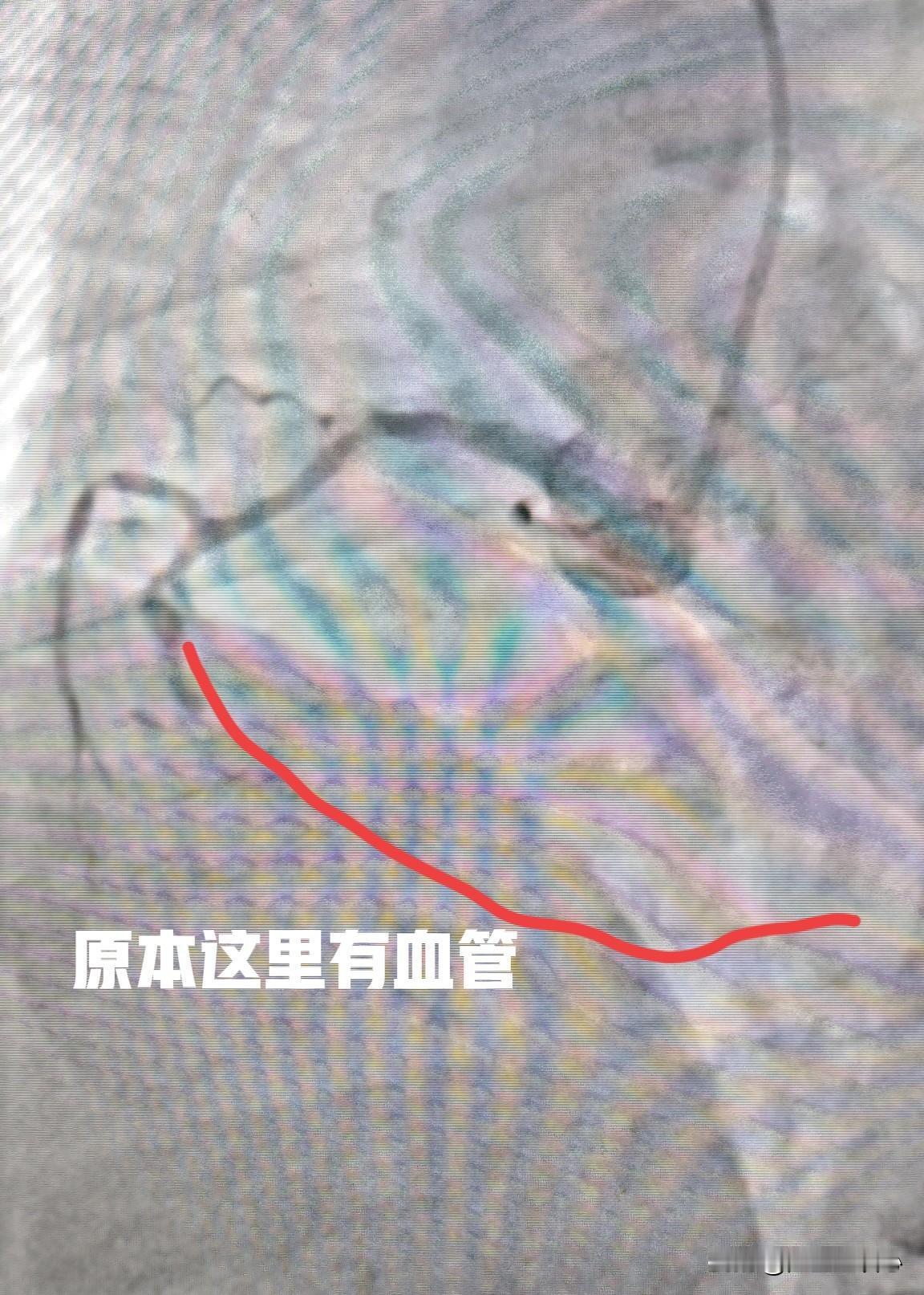 右冠脉闭塞打通了。71岁男性患者，最近半年反复出现胸闷心慌的症状，尤其是日常活