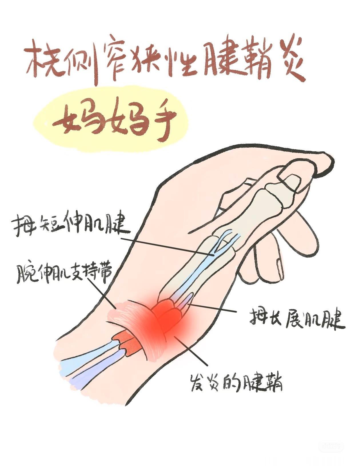 运动康复【常见手腕损伤盘点】手腕不同的位置，也有不同的损伤原因，来看这份图解盘
