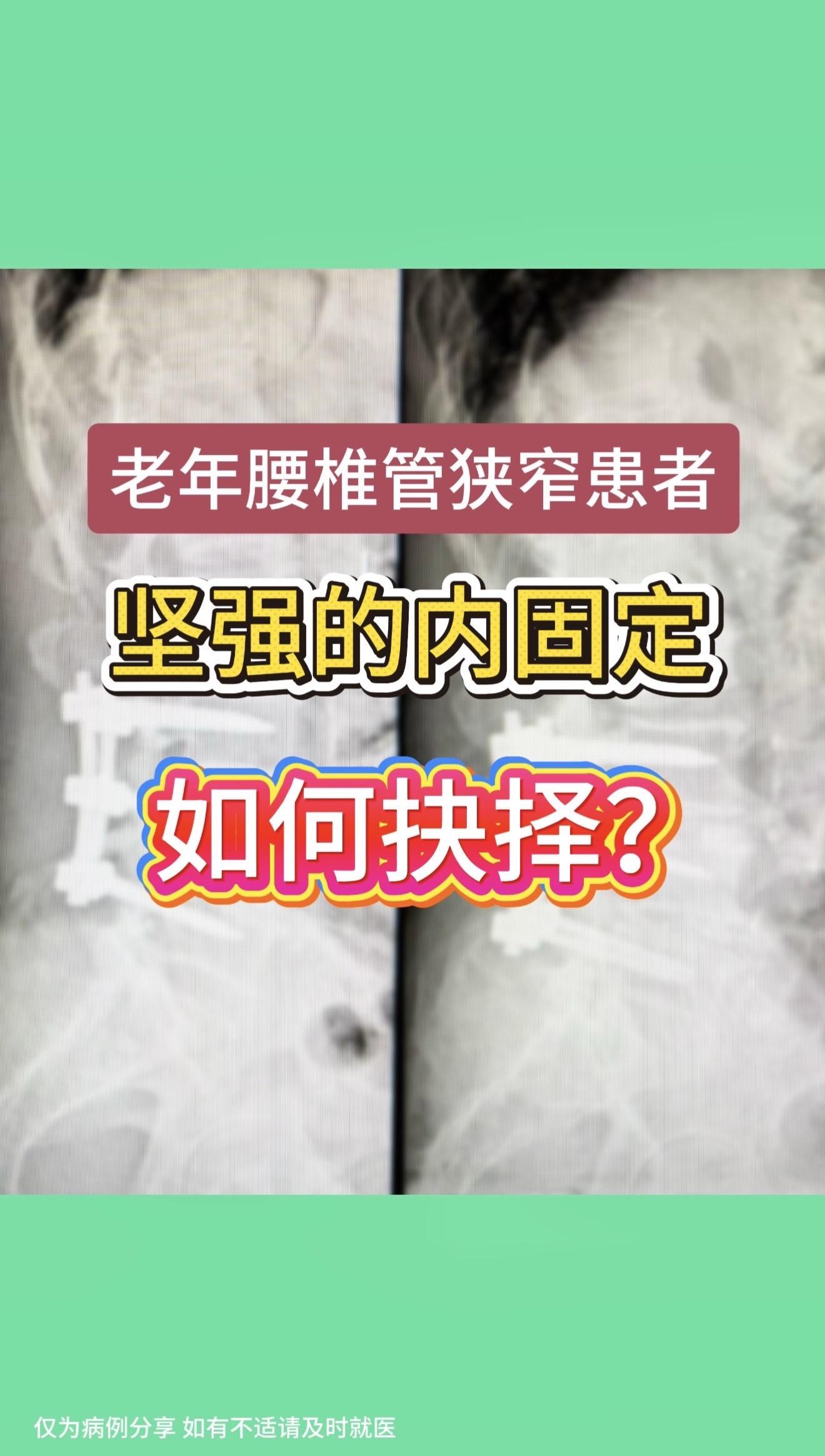 老年腰椎管狭窄症。老年腰椎管狭窄患者越来越多，很多伴有腰椎不稳定需要内...