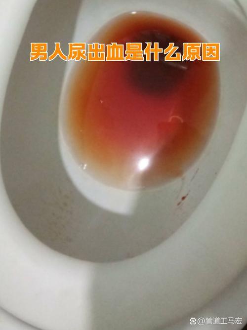 不痛的血尿别忽视！杭州72岁大爷尿出洗肉水，拖到确诊癌症72岁的李大爷退休后
