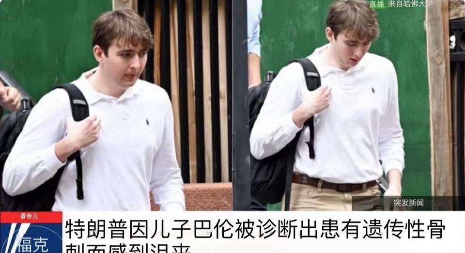 福克斯新闻报道：特朗普的小儿子巴伦被诊断出患有遗传性骨刺，并且情绪低落。这一消