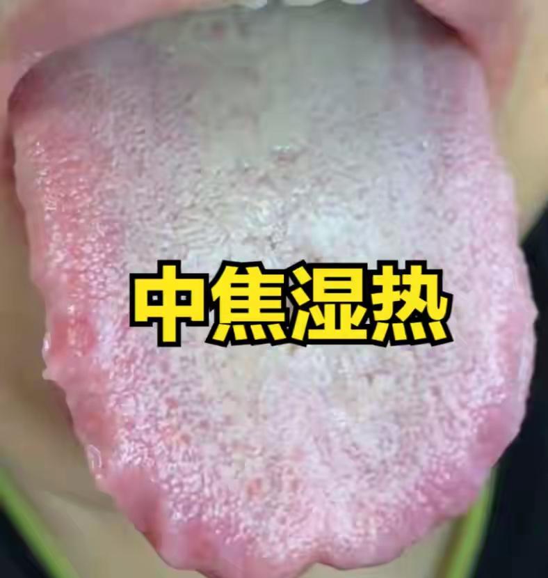 三妙汤+茵陈蒿汤加减：专攻中焦湿热，清脾胃、复中气、充宗筋大家好，我是陈大夫。