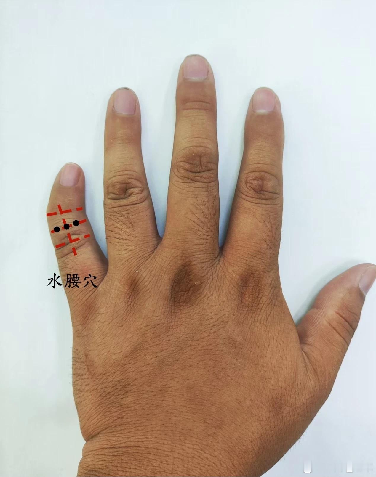腰痛，水腰穴水腰穴源自董氏奇穴位置：在手背面，小指第二节中央点是一穴，中央点偏