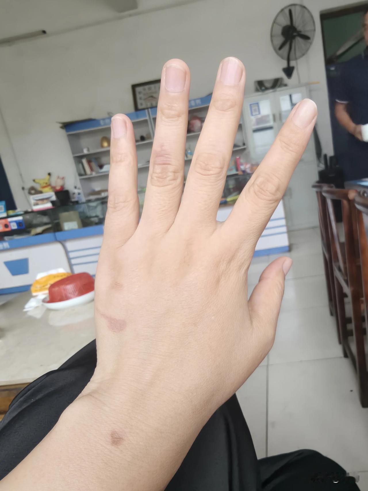 这是一只兽医的手，哪有“岁月静好”啊——看看这手背、手腕上的淤青，不是被猫猫狗狗