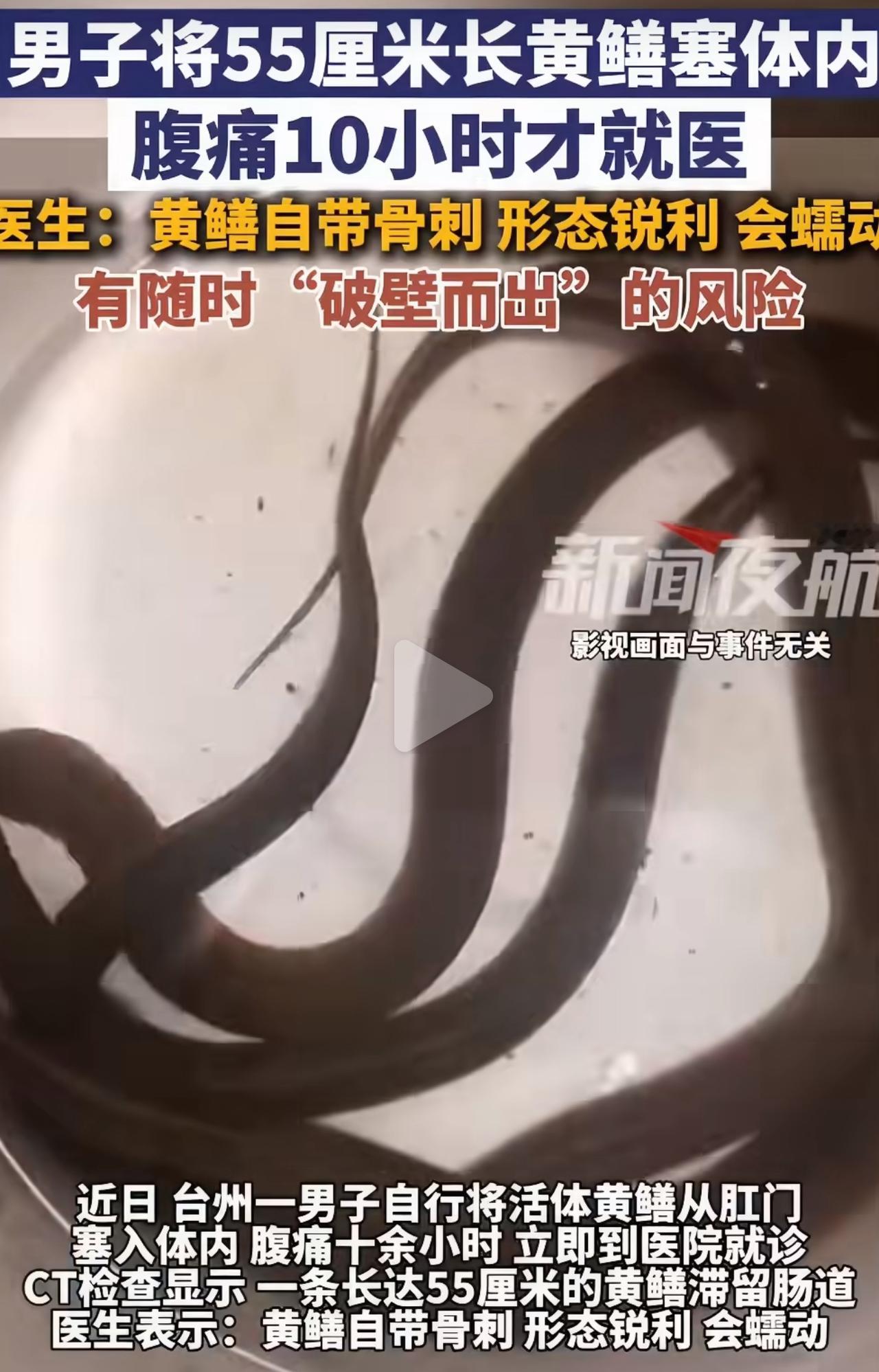 男子一时猎奇，私自把一条55厘米的活黄鳝塞进身体。刚出现腹痛不适感时，他心里满是