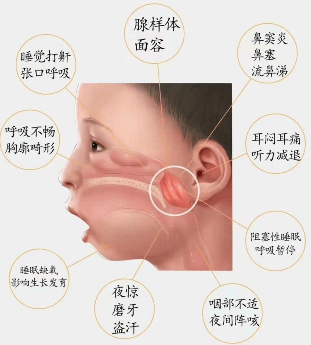孩子腺样体肥大，没有那么复杂！中医1000年前，就有解药！看着孩子因腺样体肥大
