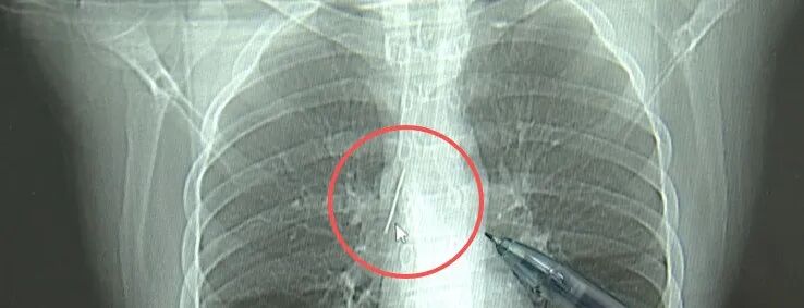 小伙胸腔内藏5cm缝衣针 或1岁时扎入