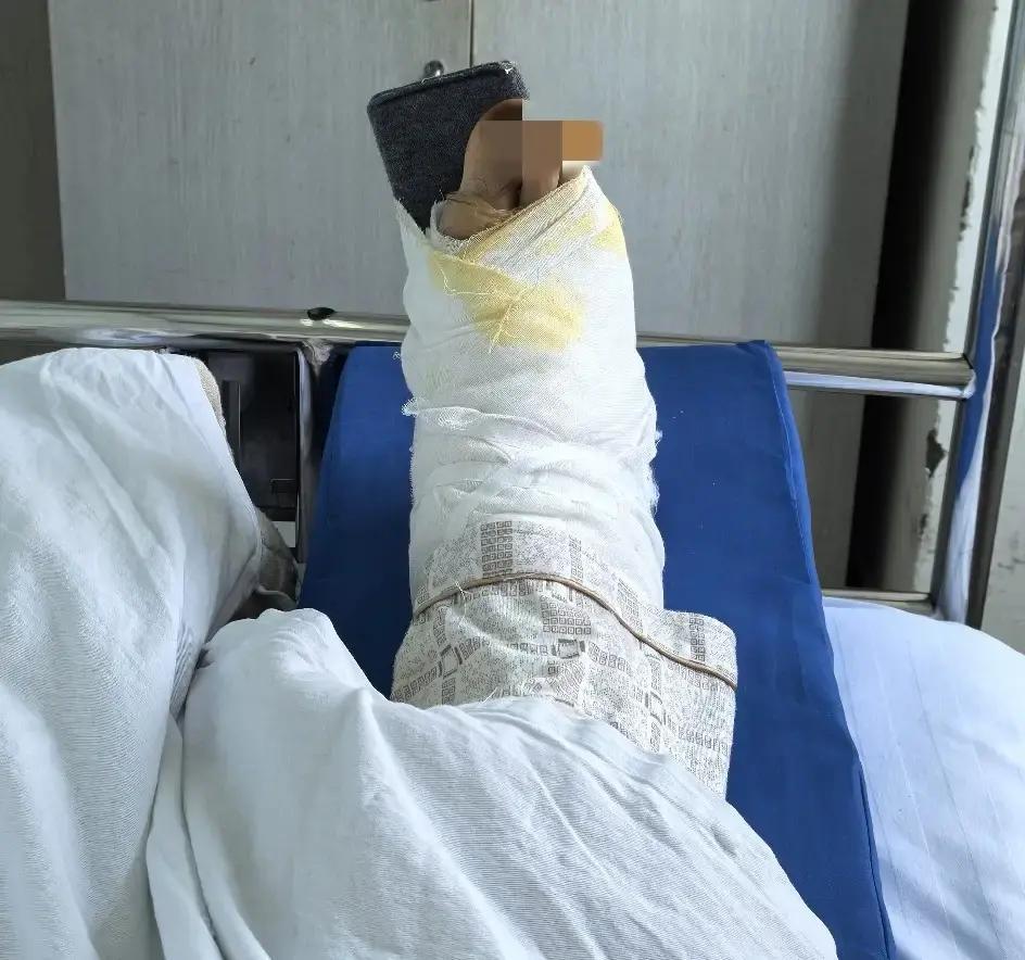 跑了16年，最终还是栽了。右脚踝，两处骨折，韧带也撕了。以前也摔，摔得比这