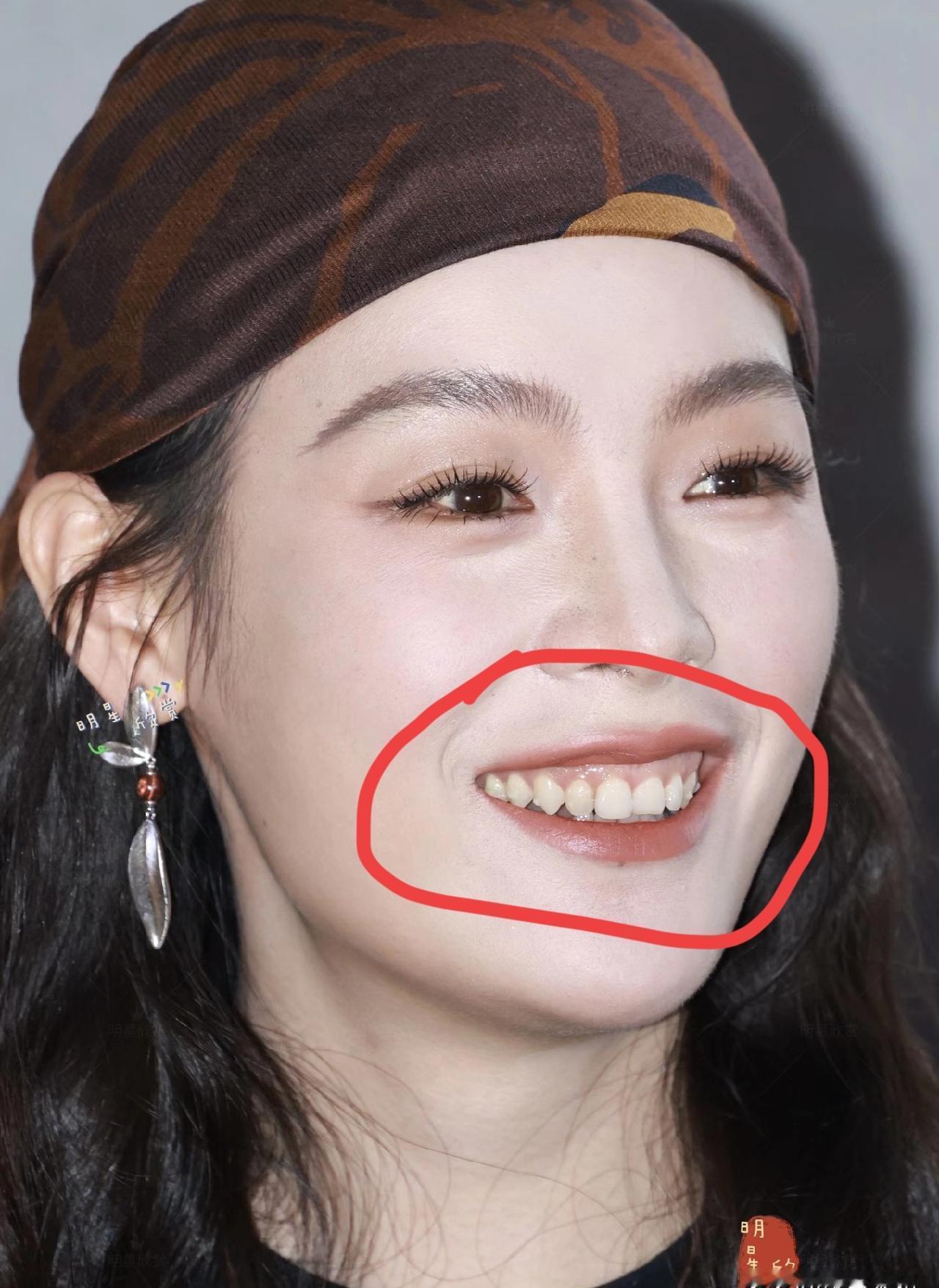 陈丽君路演一笑，牙上那个小钢点藏不住了。你发现没有，她最近说话时嘴唇开合特别精