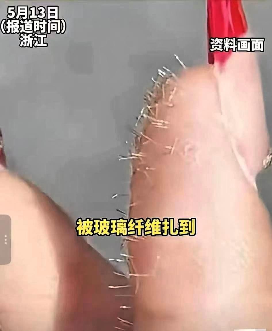 浙江，一女生不小心被玻璃纤维扎满手，又刺又痒看不见，她没去医院、没拿针乱挑，直接