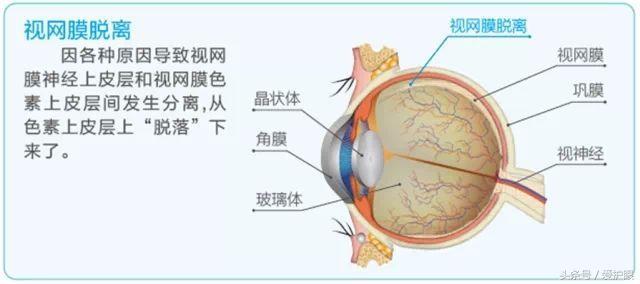 高度近视的危害比你想象中要严重
