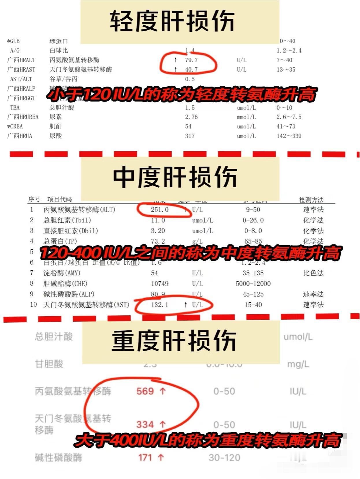 转氨酶升高的3个等级，应该怎么办？转氨酶是人体代谢过程中必不可少的