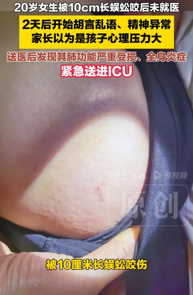 后怕！湖北武汉，一名女大学生被10厘米长的蜈蚣咬伤后，仅简单自行处理，殊不知毒素