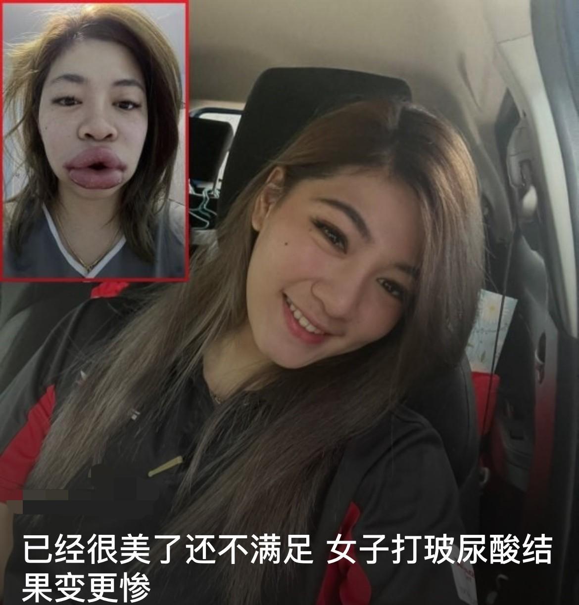泰国一名女子因追求更高颜值，选择在下巴与嘴唇注射玻尿酸，未料却因严重过敏反应导致