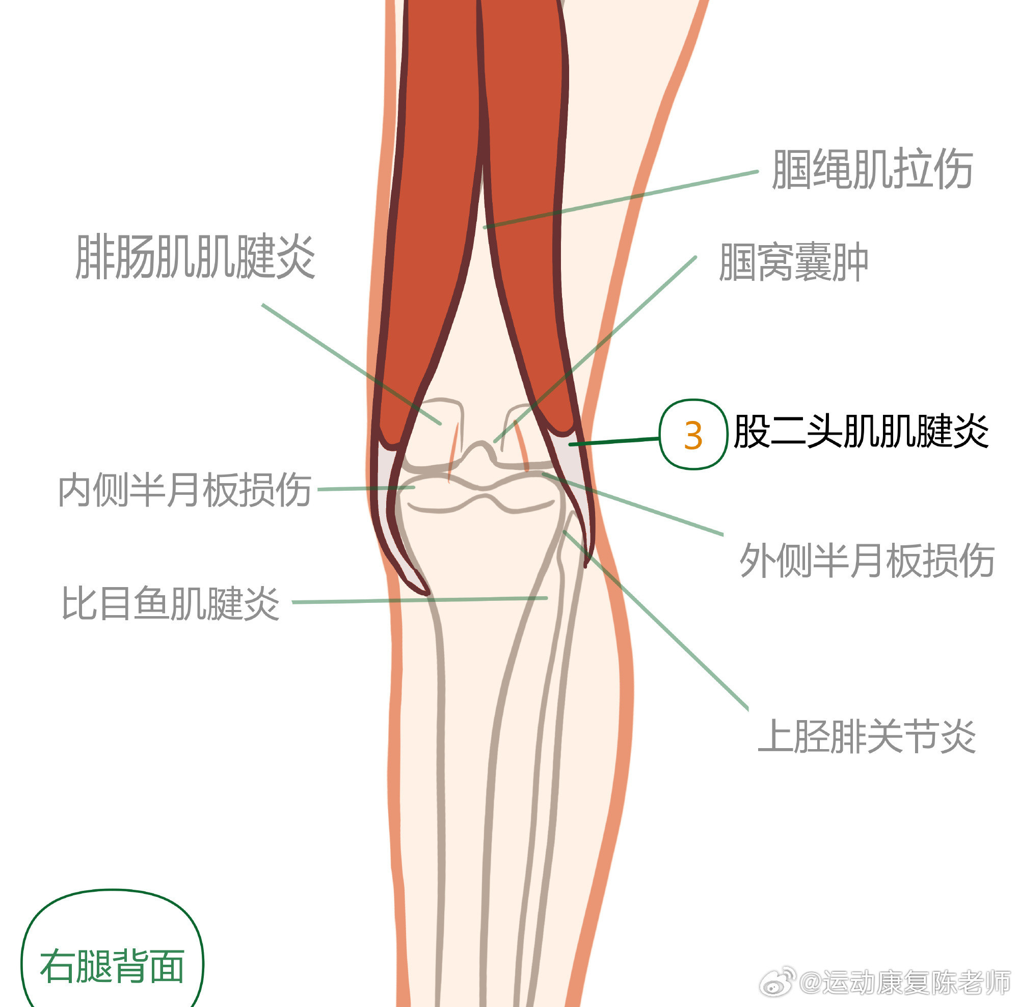 膝盖疼痛居家自测中午讲了膝盖自测，平时提到膝关节前侧的损伤比较多，把后侧的这