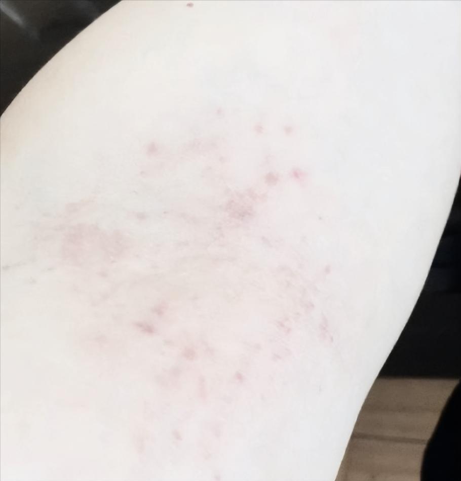 人为什么会得湿疹？原来湿疹是这样来的，现在知道还不迟 湿疹，皮肤的“烦人精