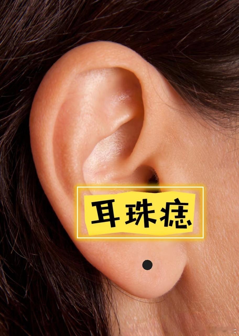 耳垂上有痣耳垂上有痣在传统相学和民间说法中，耳垂上有痣被赋予了多种意义。-耳