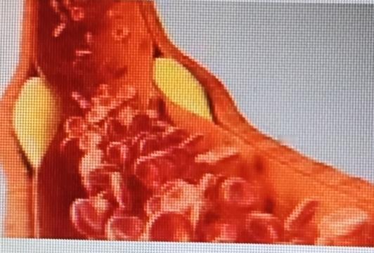 多名院士呼吁糖尿病人要撤下一些餐桌食物，这些食物比甜食还伤血管。很多糖友一心控糖