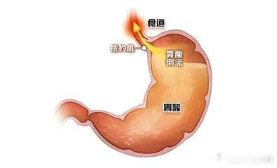 全民慢病健康科普计划全民营养提升计划健闻登顶计划【5个坏习惯让胃酸反流】1、饮