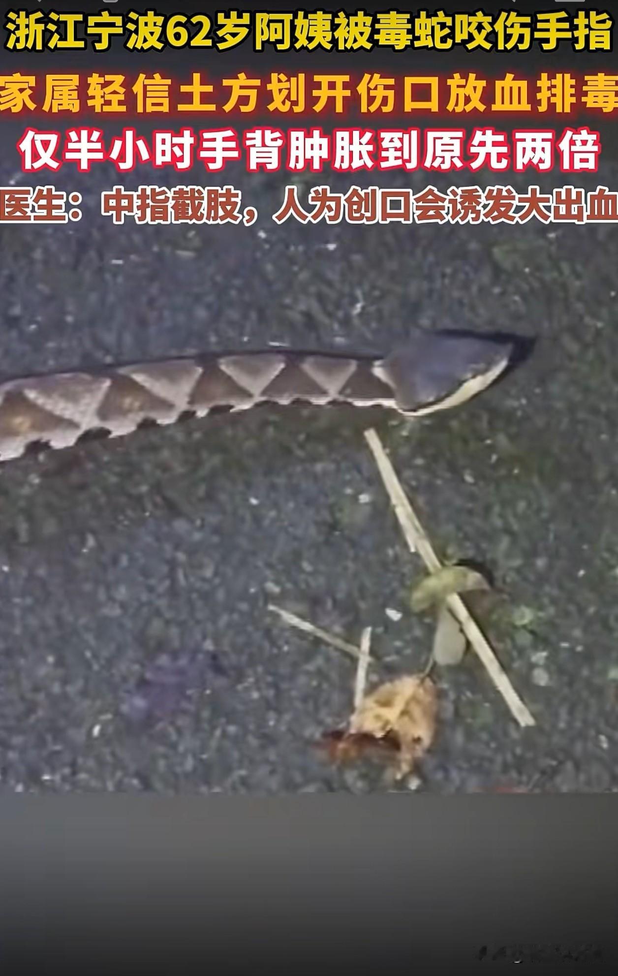浙江宁波62岁的胡阿姨在田间拔草时，左手无名指和中指被五步蛇咬伤。家人一时心急，