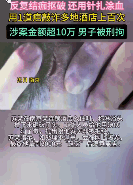 真是个狠人！一男子曾在酒店洗澡时不慎碰破旧伤获赔后，意外发现了“商机”。为了让伤