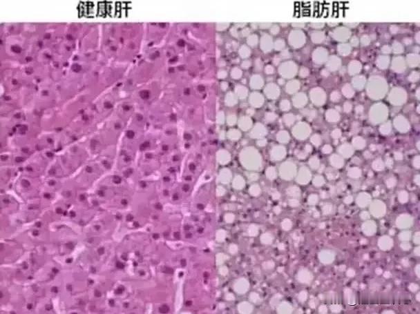 脂肪肝是肝脏被脂肪包住了吗?不是被脂肪包住了，是每一个肝细胞中含有大量的油脂成分