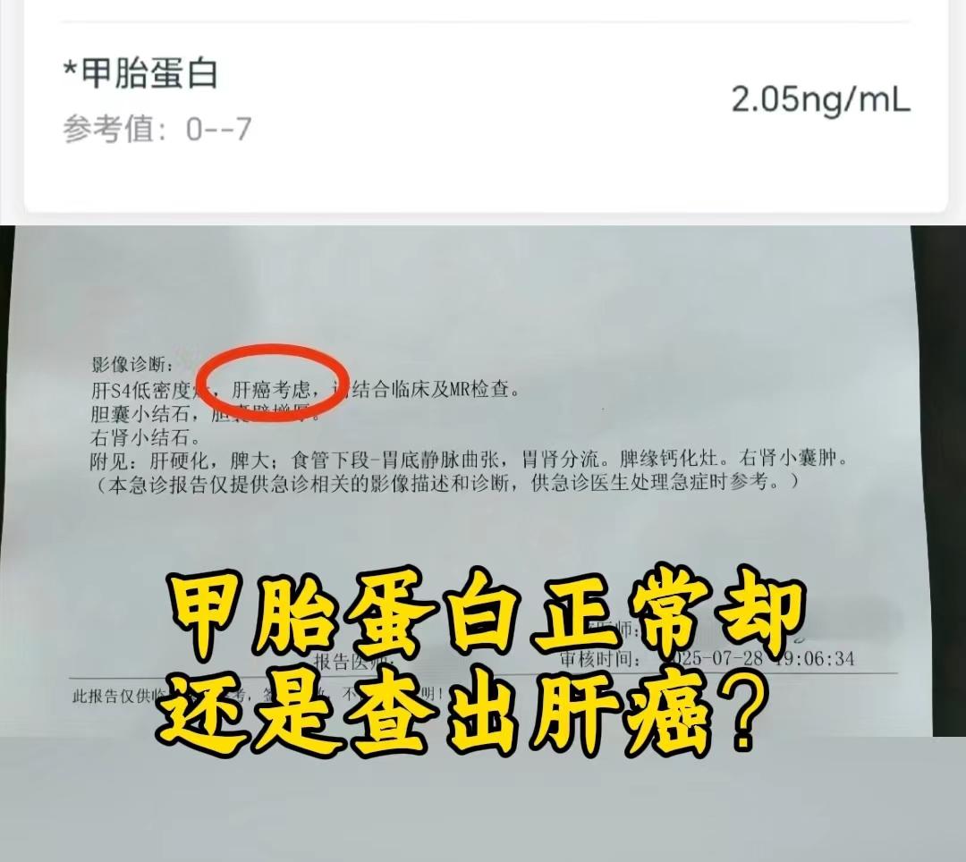 甲胎蛋白正常却还是查出肝癌？是怎么回事？ 甲胎蛋白正常也可能查出肝癌...