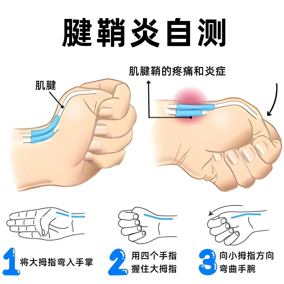 腱鞘炎手腕疼痛、活动受限，腱鞘炎怎么办？给大家分享2个关键动作：01，快速