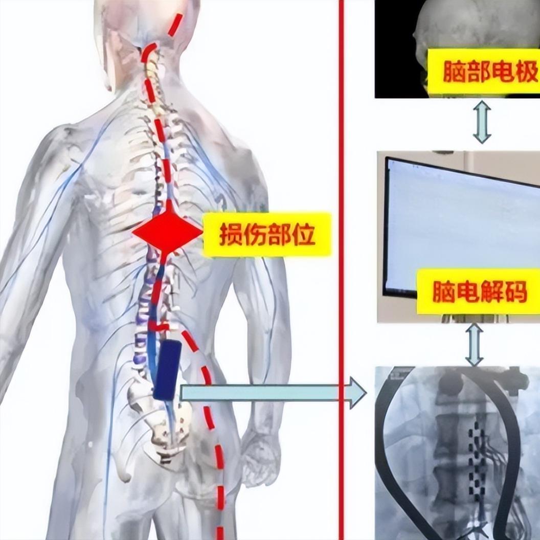 脊髓损伤最怕这5件事！踩中一个，康复可能白费第一，刚受伤那会儿，千万别让人瞎动