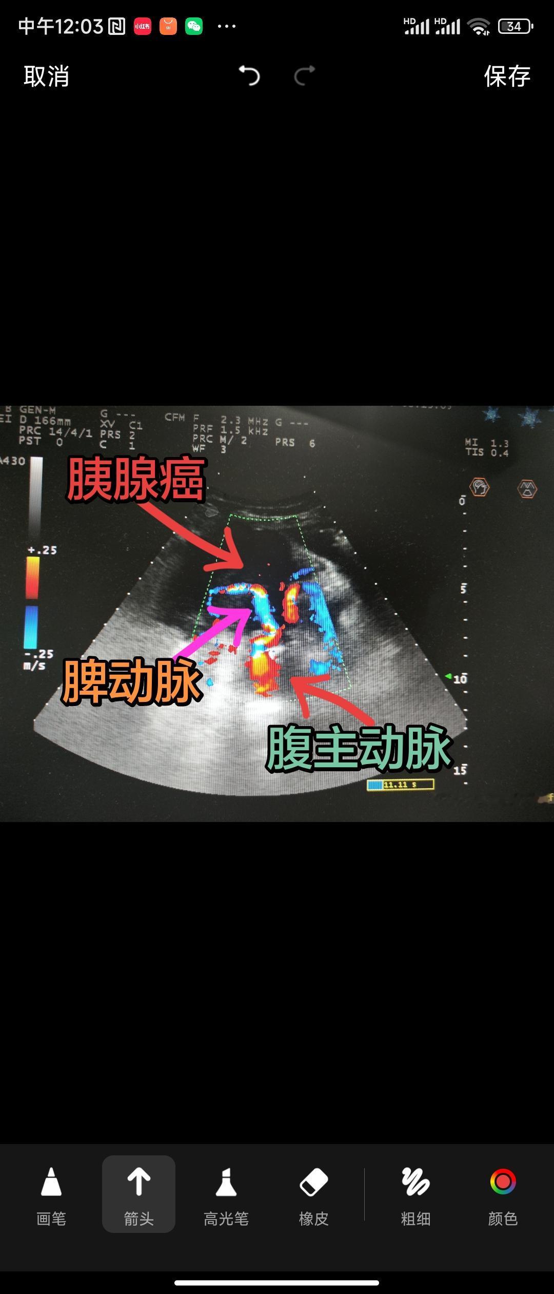 9.5厘米巨大胰腺癌，海扶刀治疗后疼痛立刻缓解，病人家属感叹海扶刀治疗效果立竿见