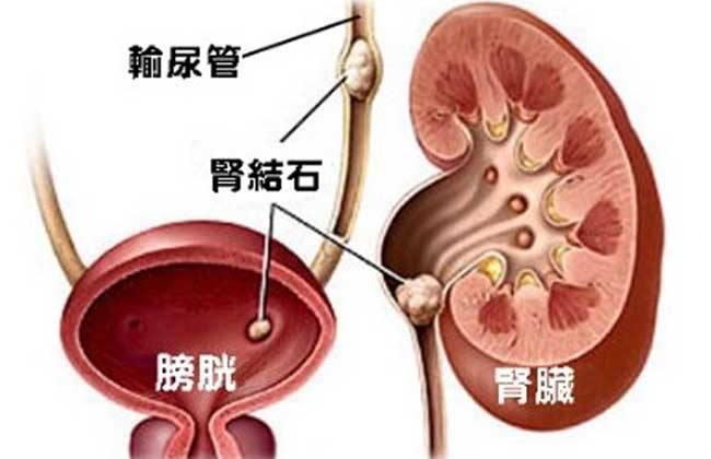 肾结石, 真能自己排出去吗?